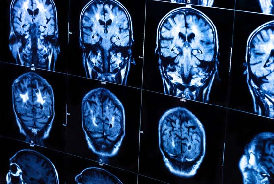 resonancia magnética cerebro humano insights
